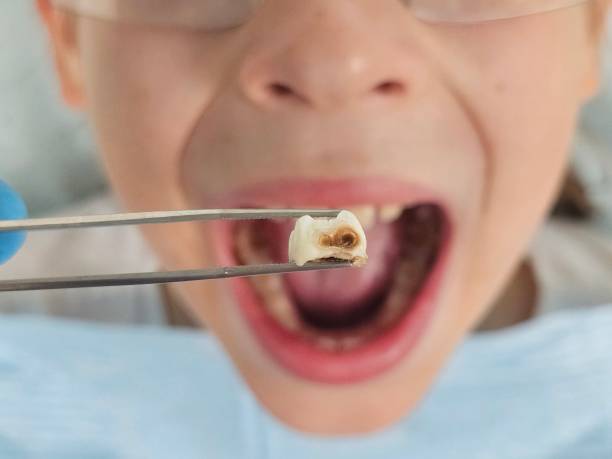 Best Emergency Dental Care for Abscessed Tooth in Tappan, NY