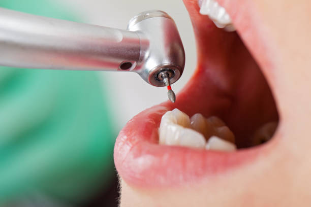 Best Emergency Dentist for Lost Fillings or Crowns in Tappan, NY